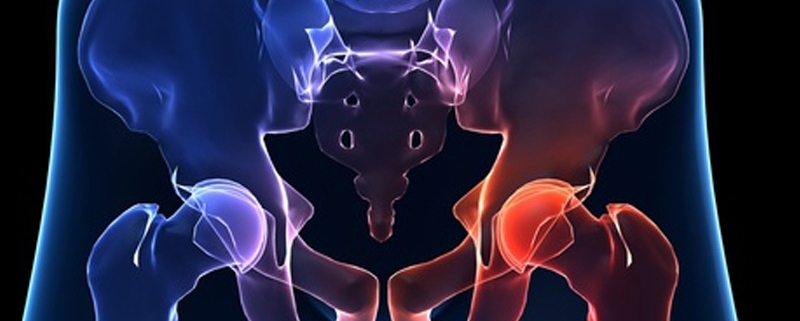 La TECAR per curare l'artrosi dell'anca