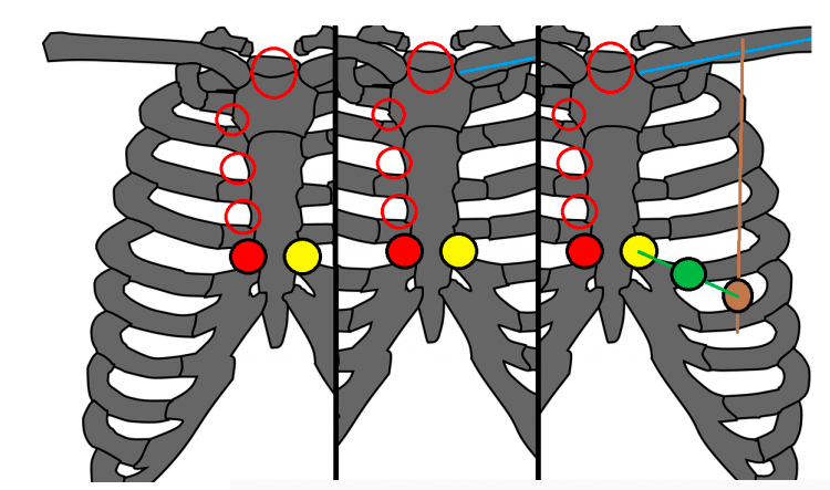 elettrocardiografo: elettrodi